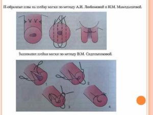 Шов на шейку матки при беременности как накладывают