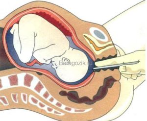 Прокол матки при беременности