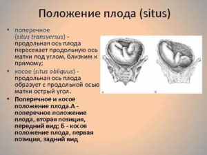 Позиция плода при поперечном положении определяется по расположению