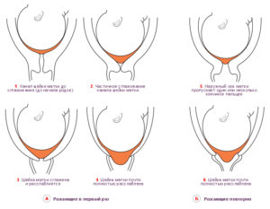 Что значит длинная шейка матки при беременности
