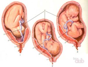 Плацента расположена высоко по передней стенке матки