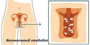 Почему после лечения молочница не проходит при беременности