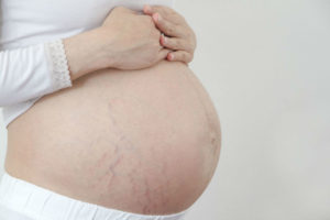 Как появляются растяжки на животе при беременности