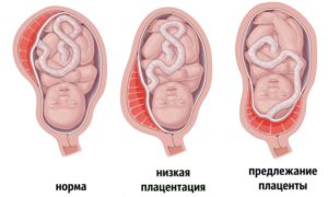 Опустилась плацента при беременности