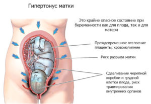 Тонус матки на 32 неделе беременности симптомы