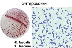 Энтерококки в мазке у женщин при беременности