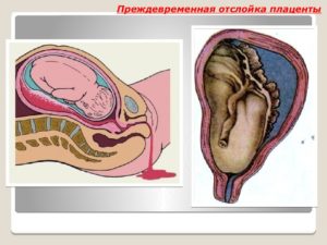 Отделение плаценты при беременности