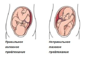 Головное предлежание плода при беременности на 20 недели