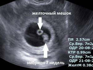 7 недель плодное яйцо