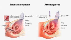 Биопсия хориона что это такое