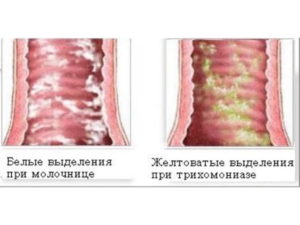 Почему после лечения молочница не проходит при беременности