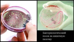 Escherichia coli у беременных
