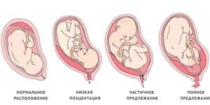 Низкое прикрепление плаценты по передней стенке матки