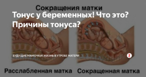 Может ли быть тонус матки без беременности