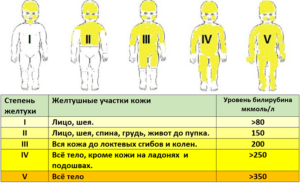 Чем опасна желтушка у новорожденных