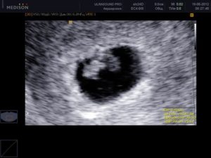На какой неделе беременности виден эмбрион на узи