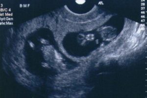 13 недель беременности двойней
