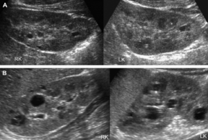 Патология почек у плода