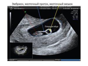 Желточный мешок при беременности