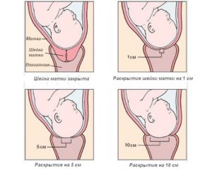 Как долго происходит раскрытие шейки матки перед родами