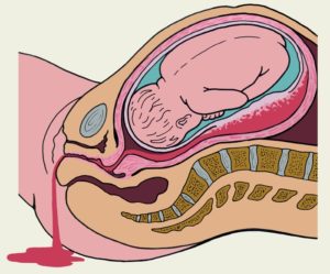 Отслойка плаценты в родах