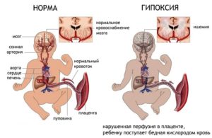 Нарушение кровотока у плода