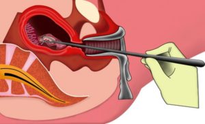 Возможно ли забеременеть после выскабливания