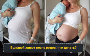 После родов большой живот