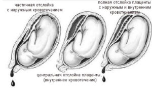 Как лечить отслойку плаценты на ранних сроках беременности