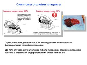 Отслойка плаценты симптомы форум