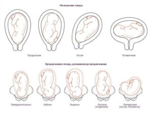 Позиции плода в матке