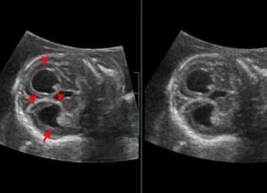 Вентрикуломегалия у плода слева