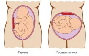 Если ребенок лежит ножками вниз как проходят роды
