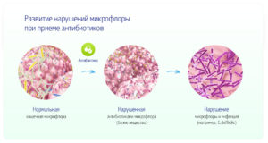 Как влияют антибиотики на кишечник