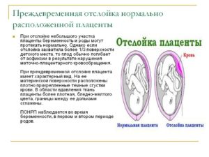 Как лечить отслойку плаценты на ранних сроках беременности