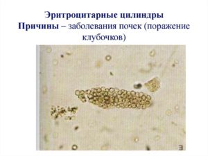 Цилиндры эритроцитарные в моче