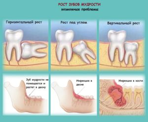 Зуб мудрости не может прорезаться