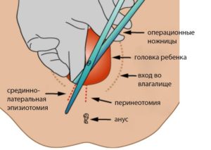 Эпизиотомия как ухаживать за швами