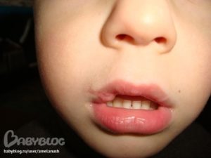 Ребенок рассек губу что делать
