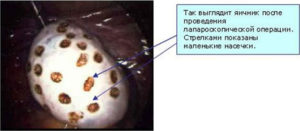 Стимуляция яичников после лапароскопии