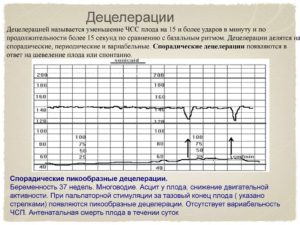 При ктг 1 децелерация