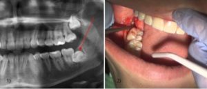 Режется зуб мудрости при беременности