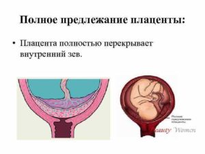 Хорион по передней стенке перекрывает внутренний зев