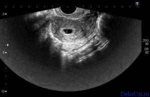 На 7 неделе беременности плодное яйцо пустое