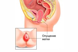 После родов опущение матки