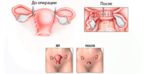 Климакс при удалении матки