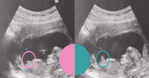 Можно ли определить пол ребенка в 10 недель