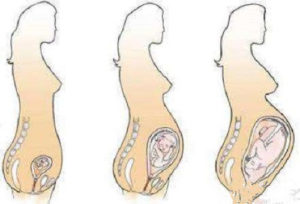 Почему матка больше срока беременности в первом триместре