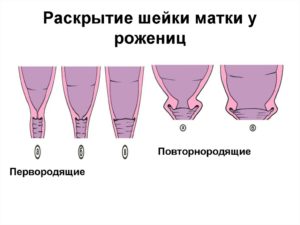 Шейка матки 1 см при беременности