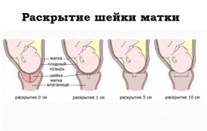 Почему не раскрылась шейка матки во время родов